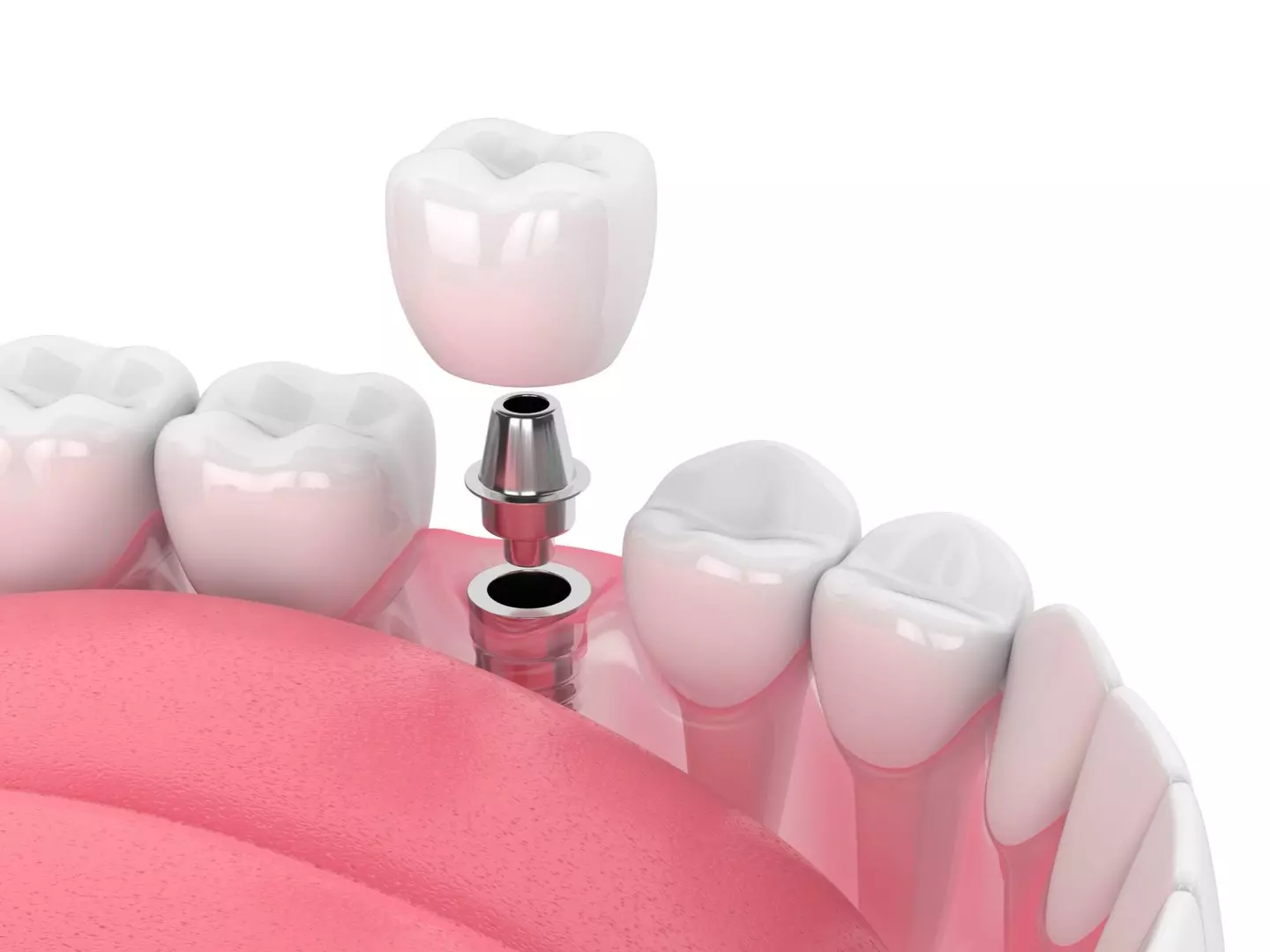 implant dentaire 3D
